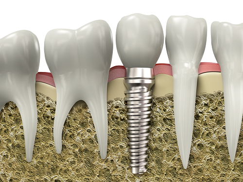 Dental Implants Santa Cruz