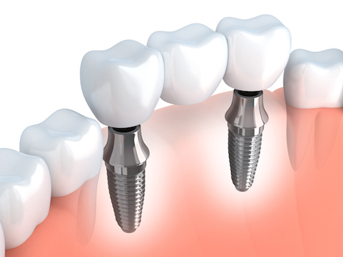dental implants bridge image