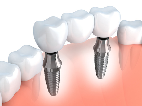 fake teeth after extraction