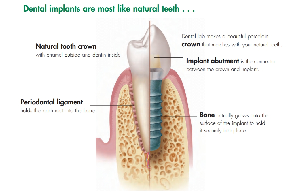 dental implants - santa cruz