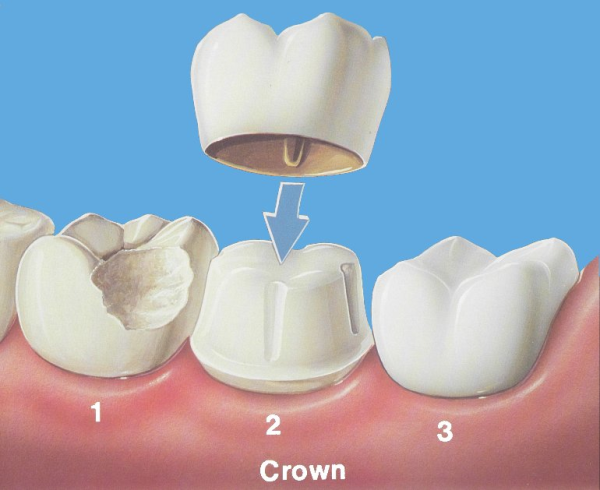 crown and bridge work